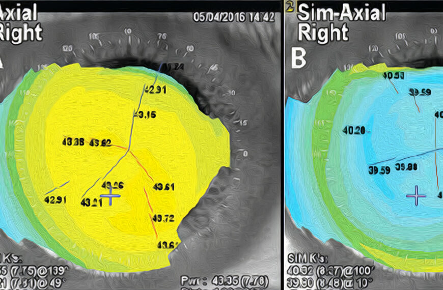 NIDEK’S QUEST: The New EC-5000 EXCIMER Laser Platform